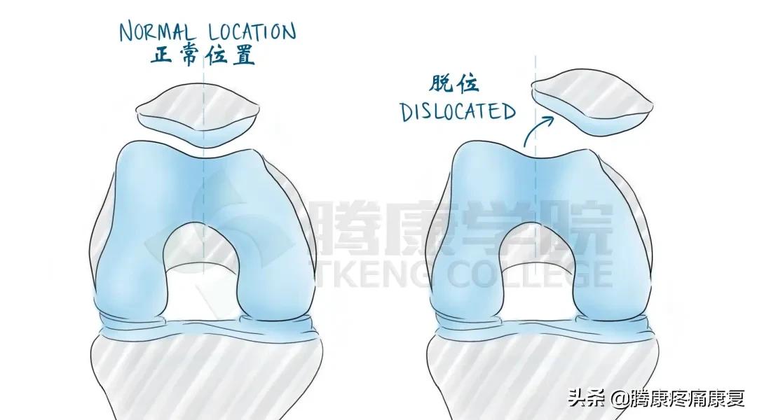 膝关节弹响的发生原因和自我锻炼,膝关节有弹响外侧疼痛是怎么回事