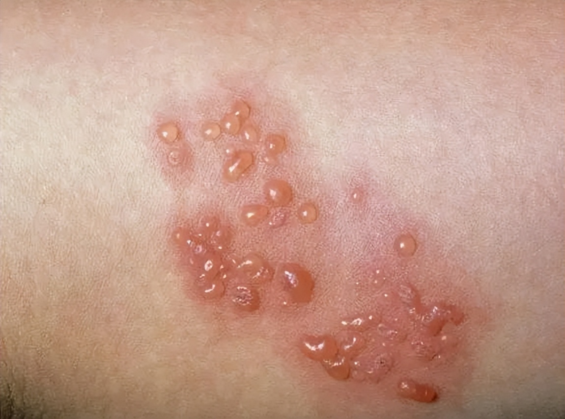 有哪些中成药治真菌肺炎,皮肤病真菌感染用什么药