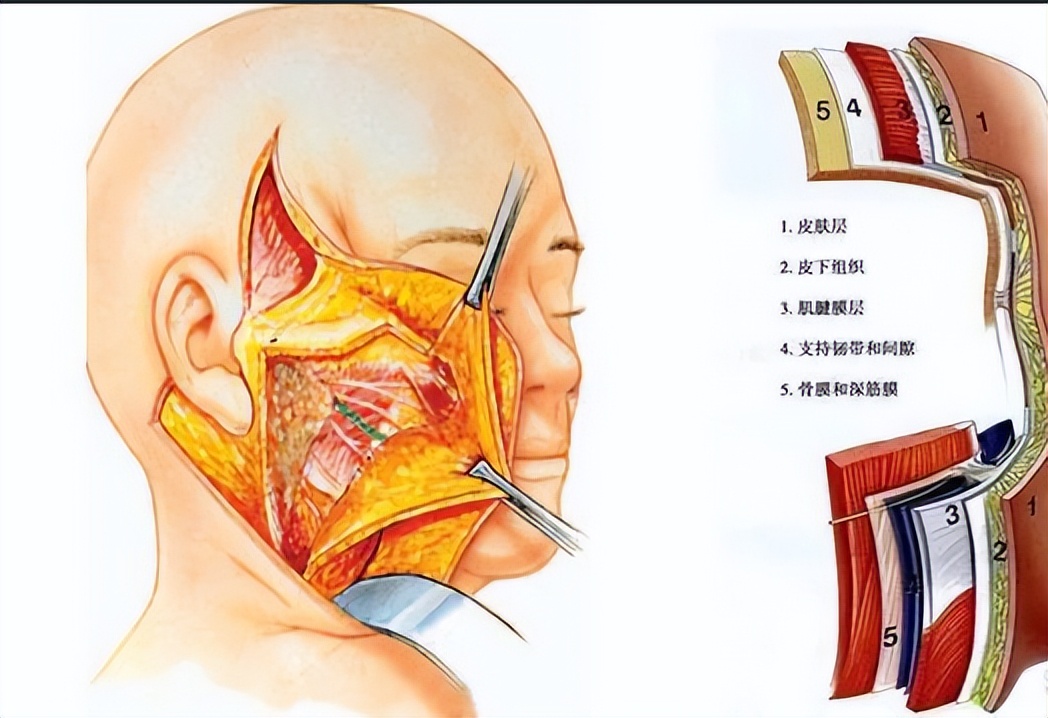 做个面部拉皮手术要多少钱啊,拉皮手术多长时间能全部消肿