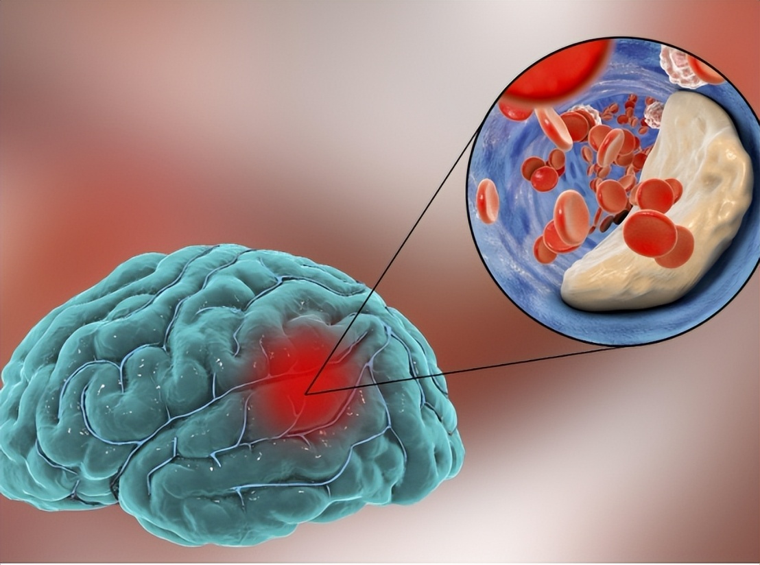 缺血性脑卒中中医治疗原则,急性缺血性脑卒中诊治指南最新版
