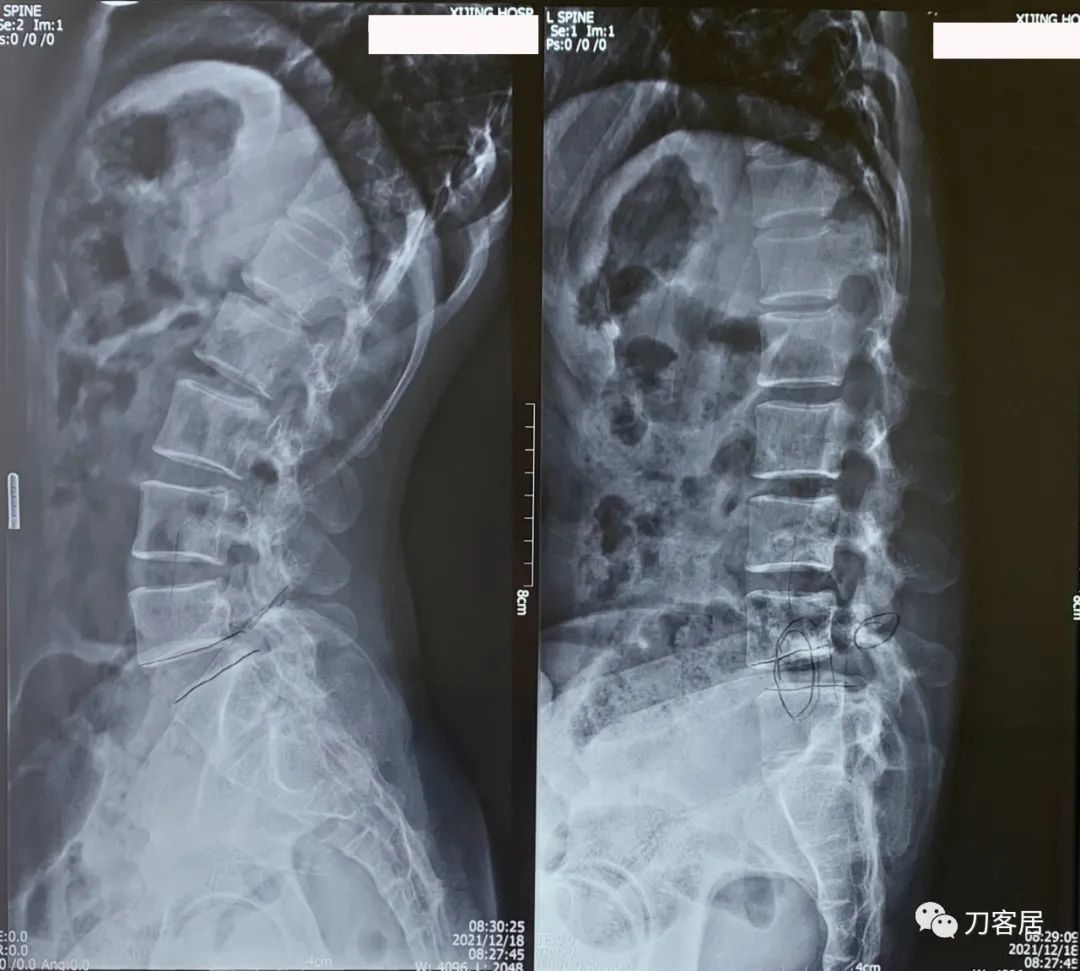 左腰峡部裂能引起右腰疼痛吗,峡部裂会腰痛吗