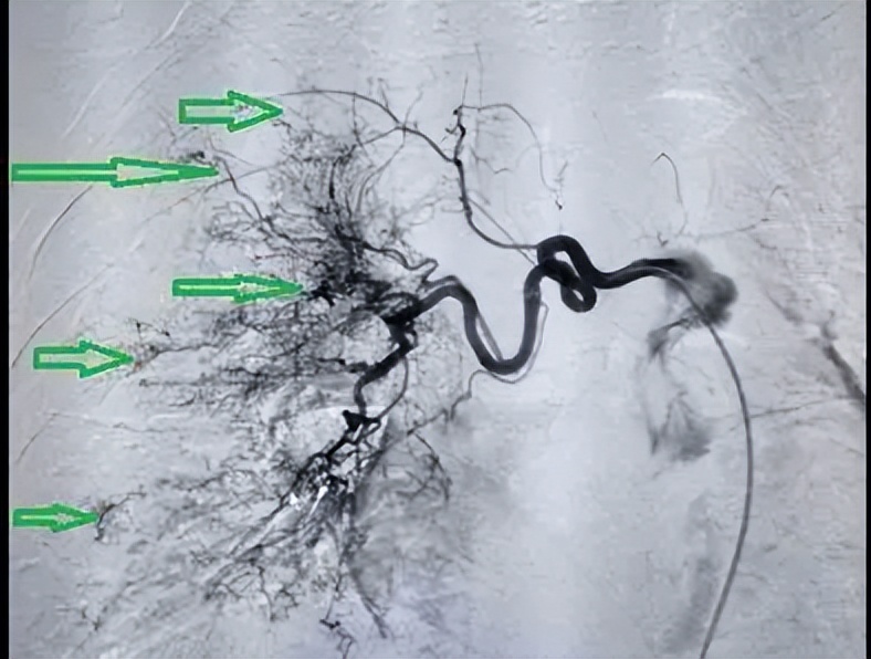 值班避坑：值班小白遇到咳血患者不要慌，这篇文章教你如何处理