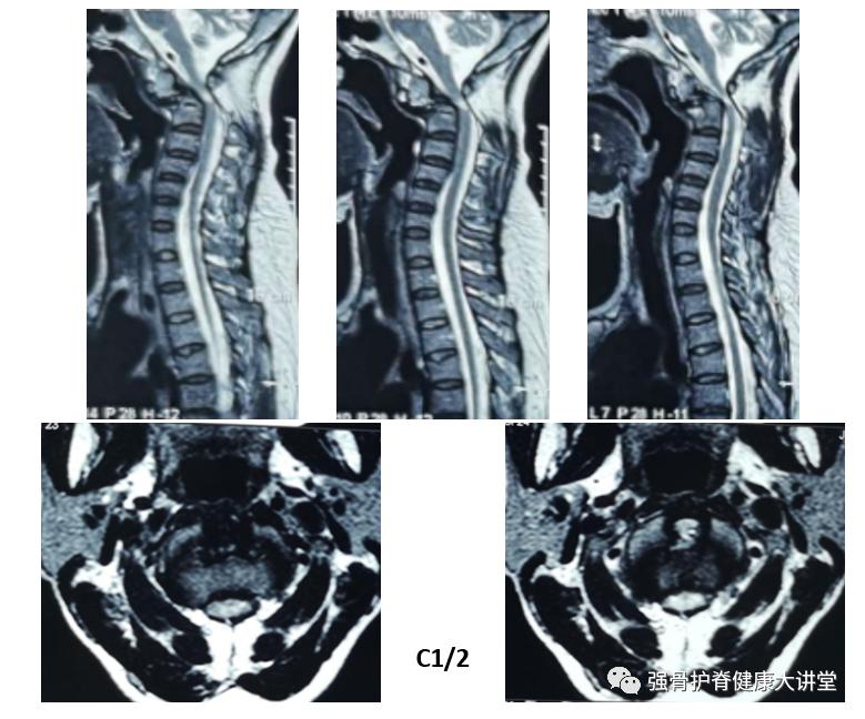 寰枢椎脱位能正骨复位吗,齿状突骨折伴寰枢关节脱位