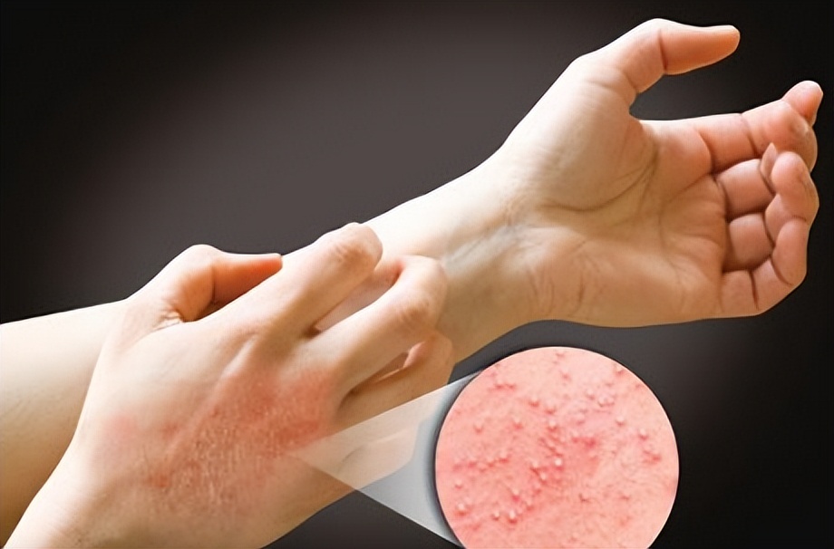 生活中最常见的4种皮肤病,皮肤科可以看多种皮肤病吗