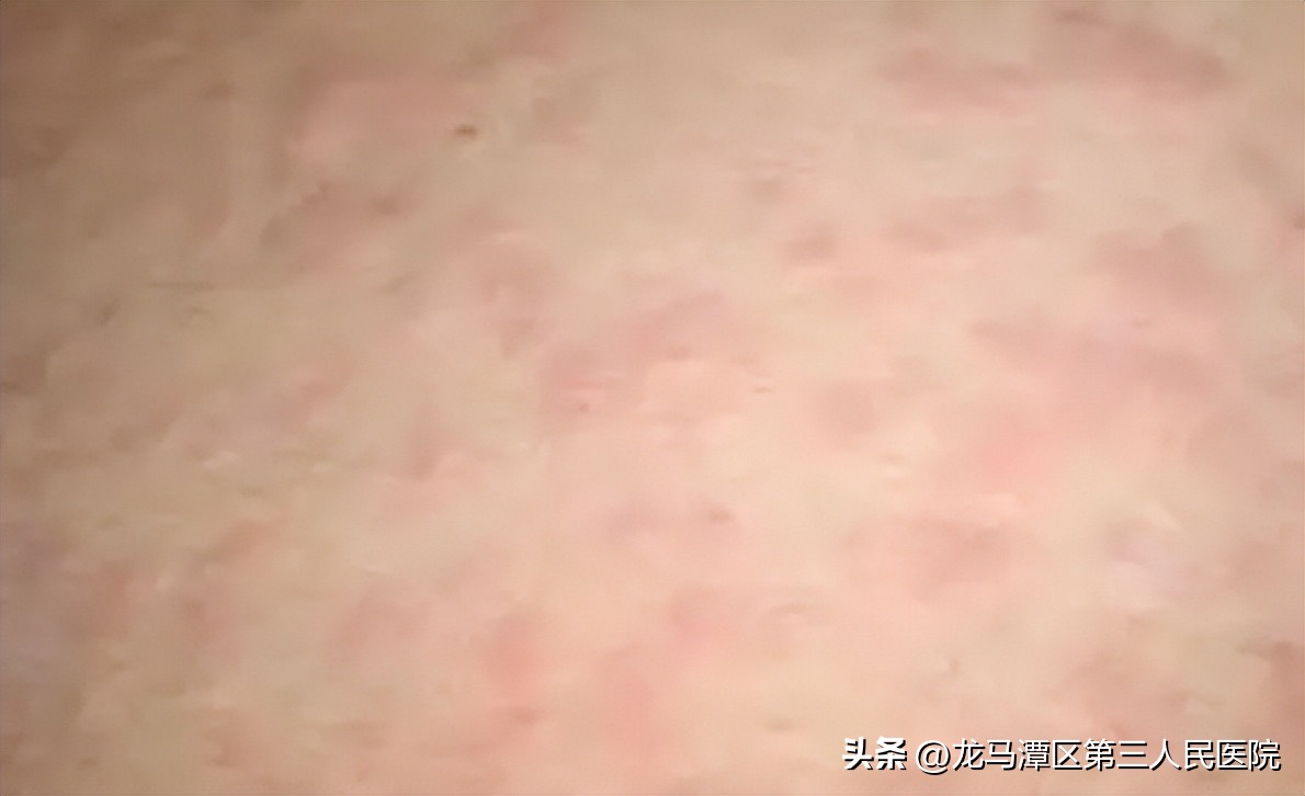 蚊虫叮咬后反复痒和红肿怎么办,海南蚊虫叮咬红肿痒怎么办