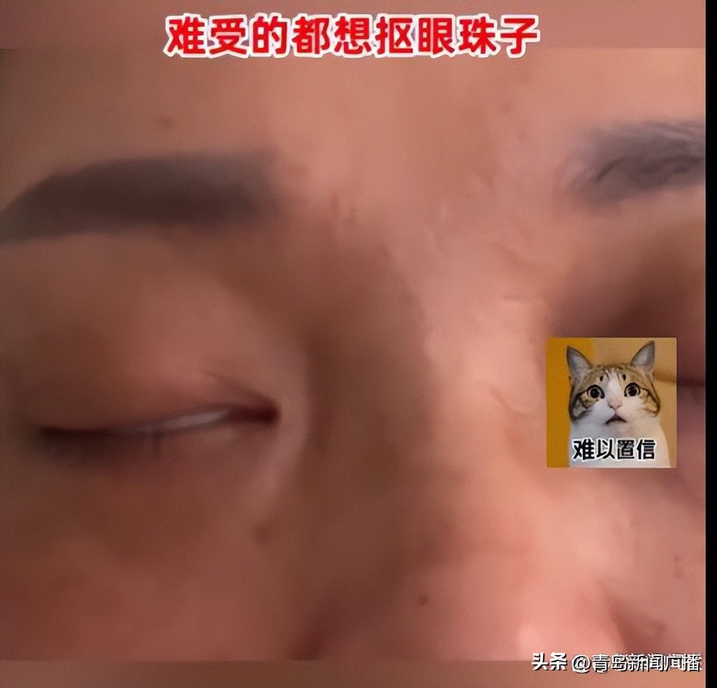 做眼袋毁容怎么活下去,女子花3000元割眼袋