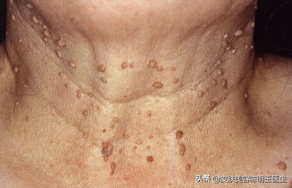 脖子上长小肉粒还能打hpv疫苗吗,50岁脖子上很多小肉粒是怎么回事