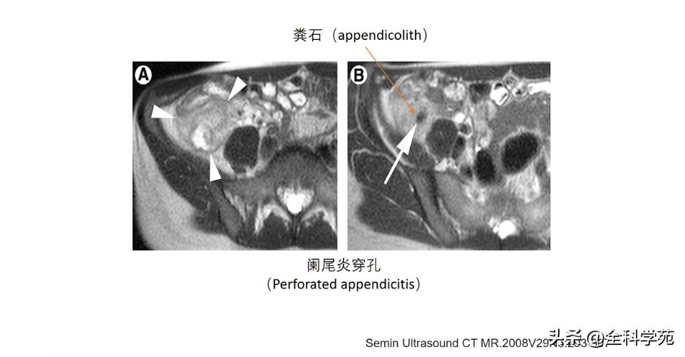 阑尾炎的讲解,关于阑尾炎的讨论总结