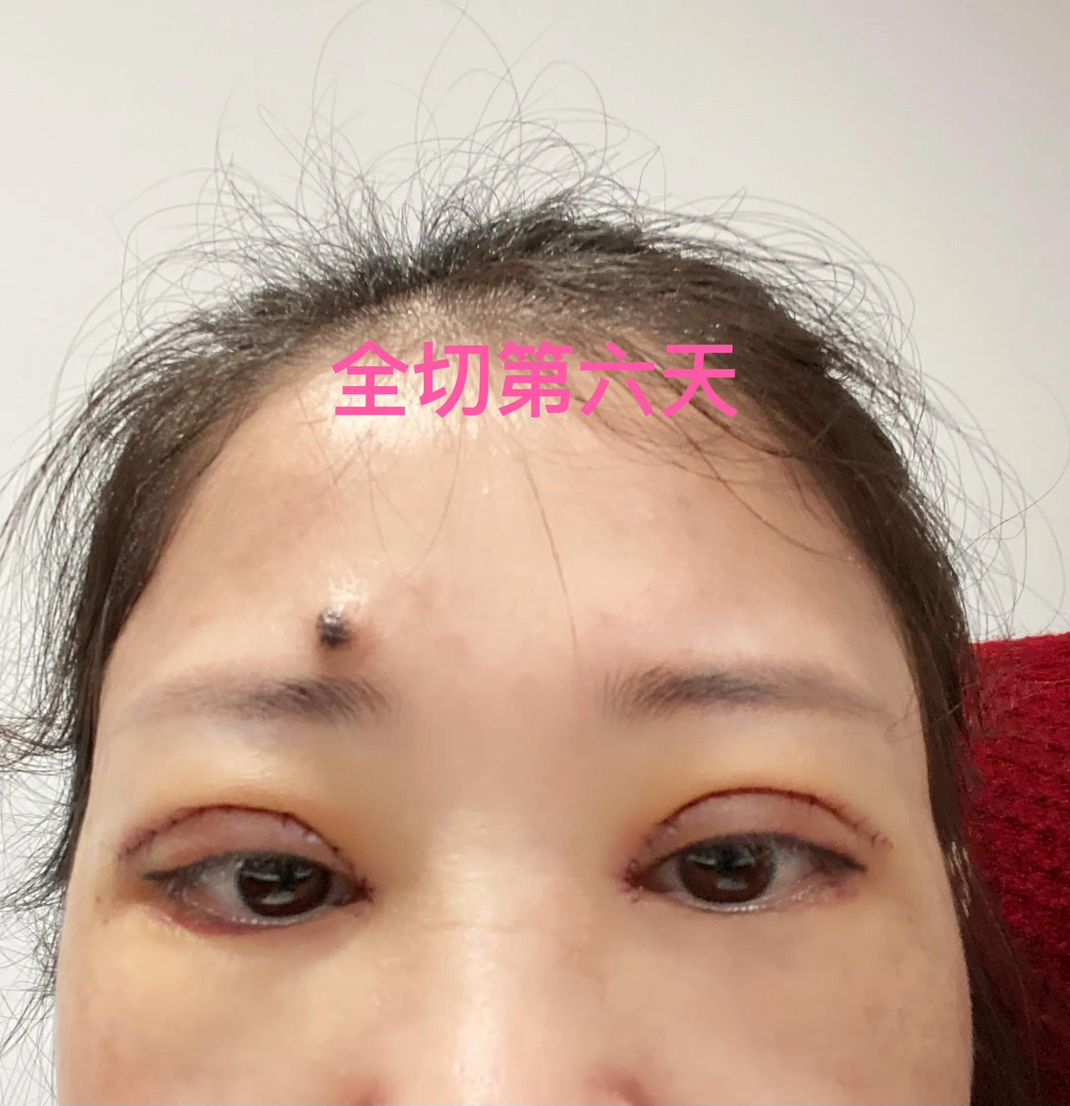 做双眼皮恢复期间能吃红糖吗,恢复最快的双眼皮