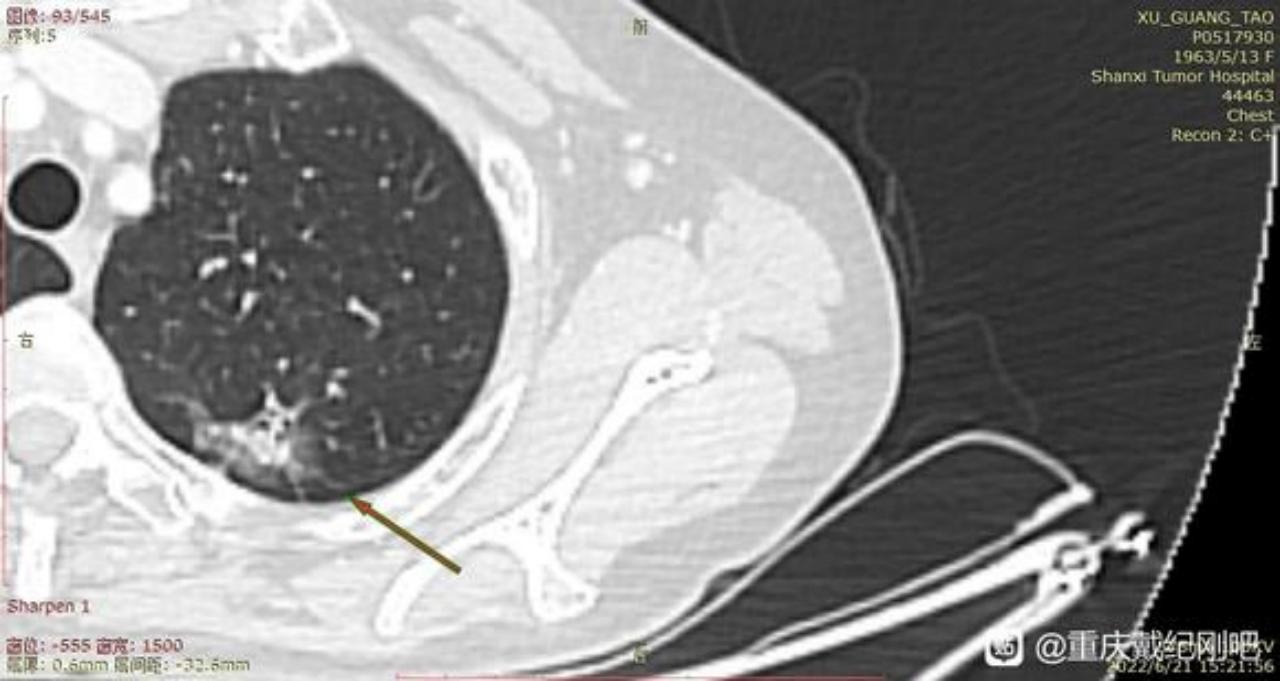 母亲腺癌,母亲确诊小细胞肺癌