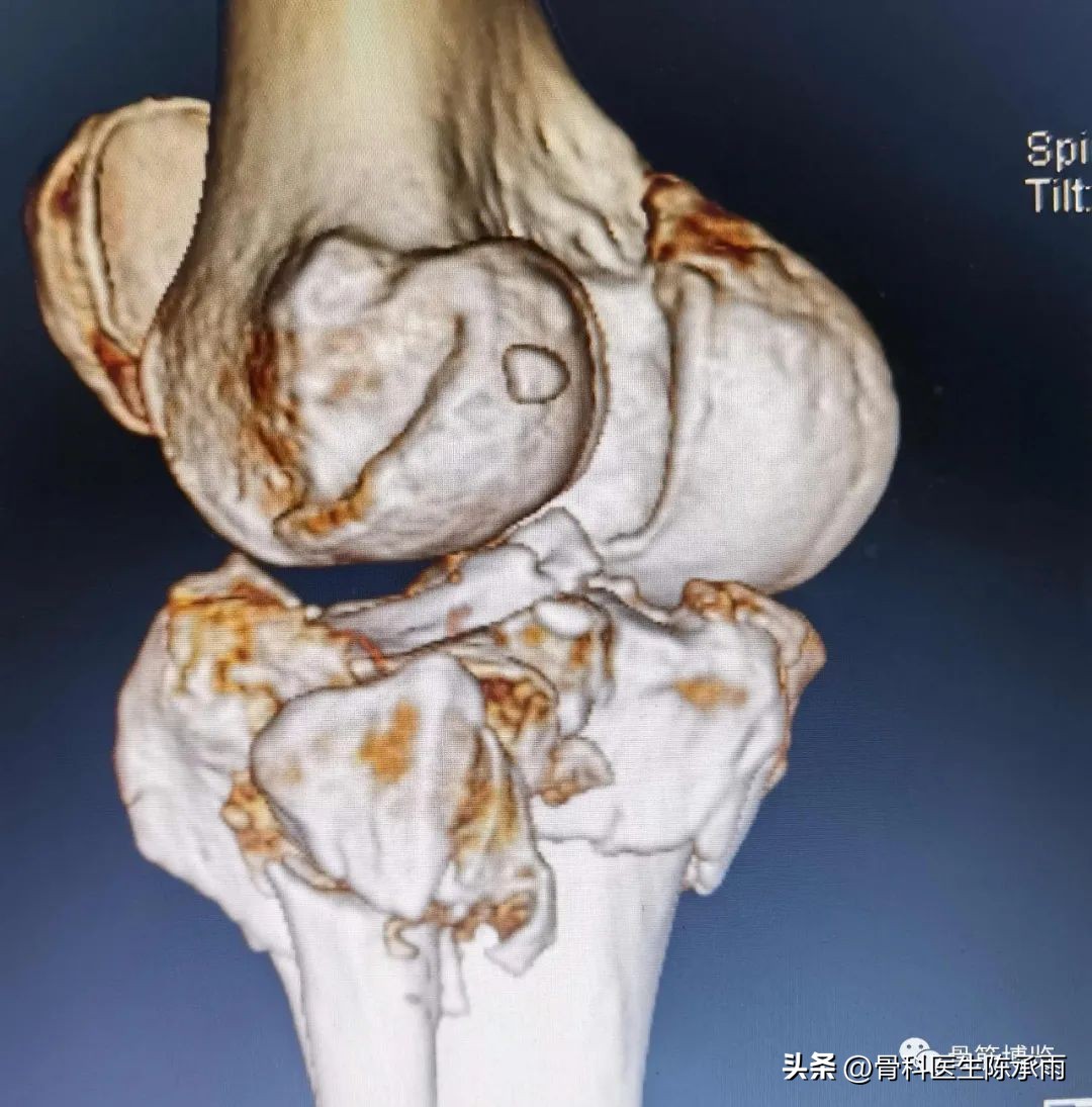 膝关节胫骨平台骨折,最近胫骨平台骨折视频