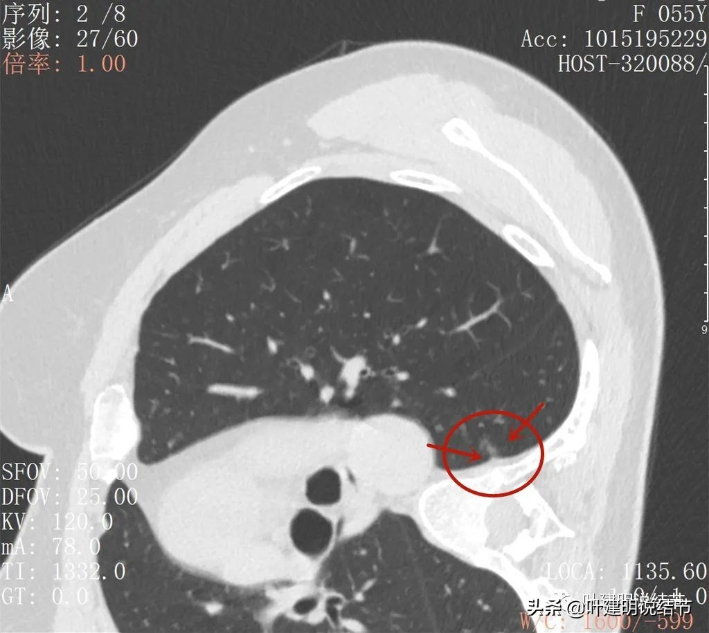病例分享：这种样子的错构瘤？我是第一次见
