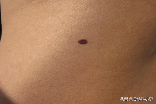 孩子身上小红点不痛不痒是什么病,身上起小红点不痛不痒按压会消失