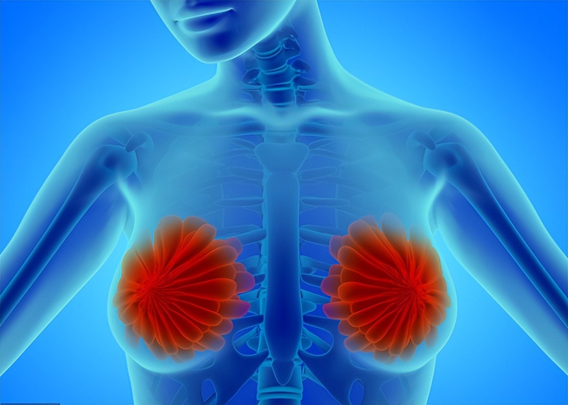 异时性双侧原发性乳腺癌10年,双侧原发性乳腺癌需要化疗吗