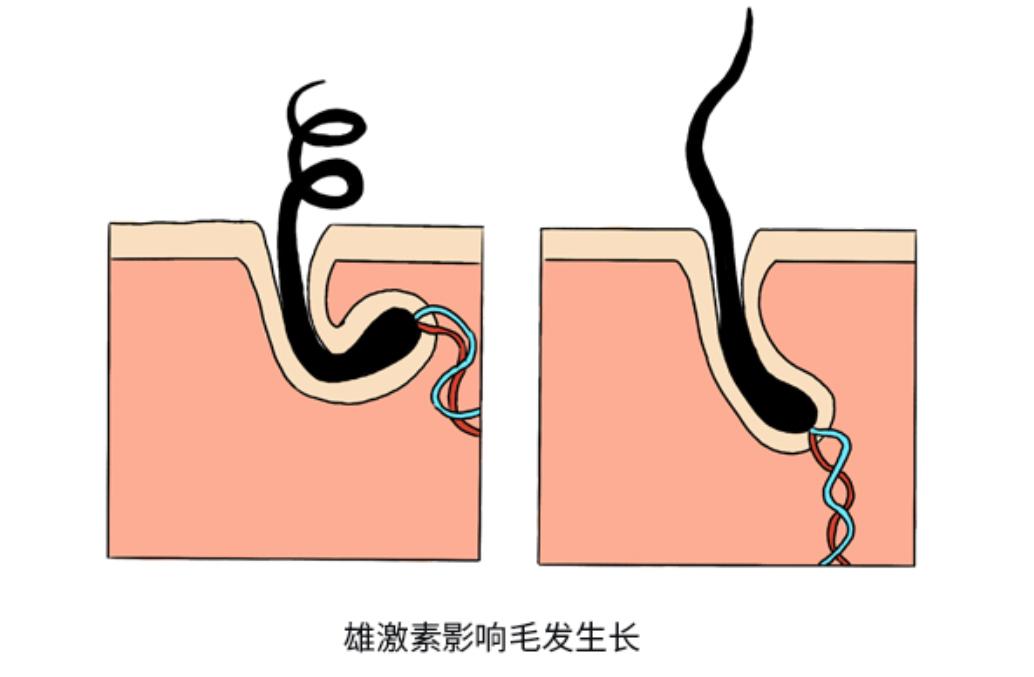 雄性激素脱发和雄激素的关系,男性雄性激素旺盛会导致衰老快吗
