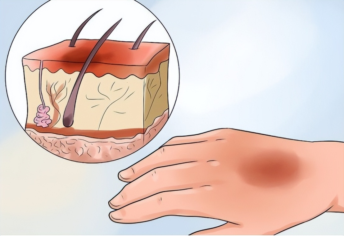 烧伤患者创面处理,烧伤创面处理的原则主要是