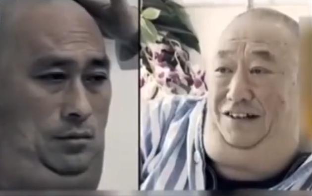 大叔喝酒30年喝出河马脖,辽宁大叔喝酒40年喝成河马脖