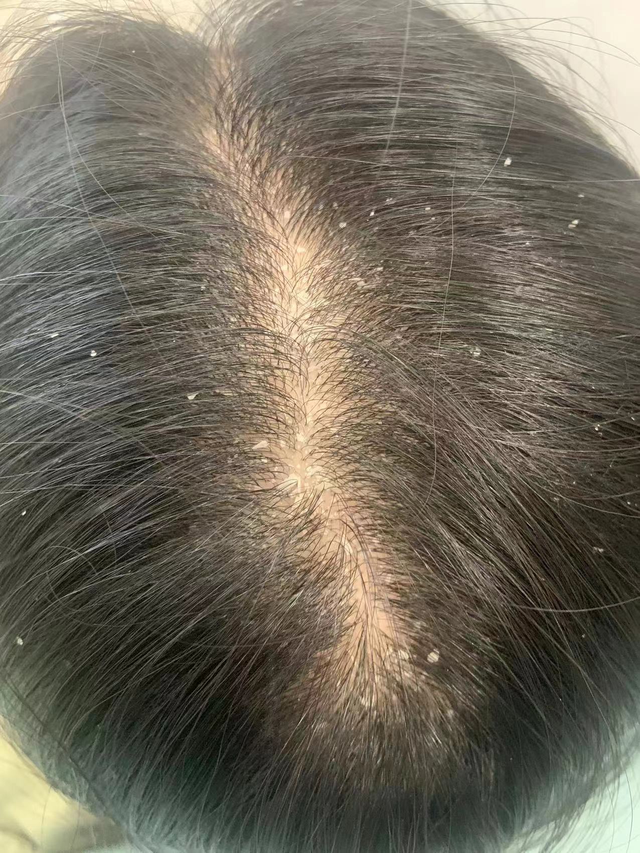 去屑洗发水排行榜哪个牌子最好用,力康王去屑洗发水对去屑有效果吗