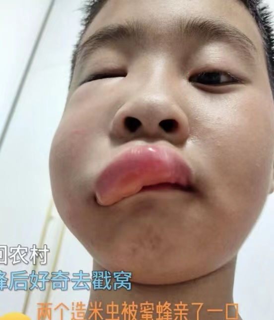 喜提完整童年！男孩好奇捅蜂窝被蜜蜂蛰，网友：亲妈都不认识他了