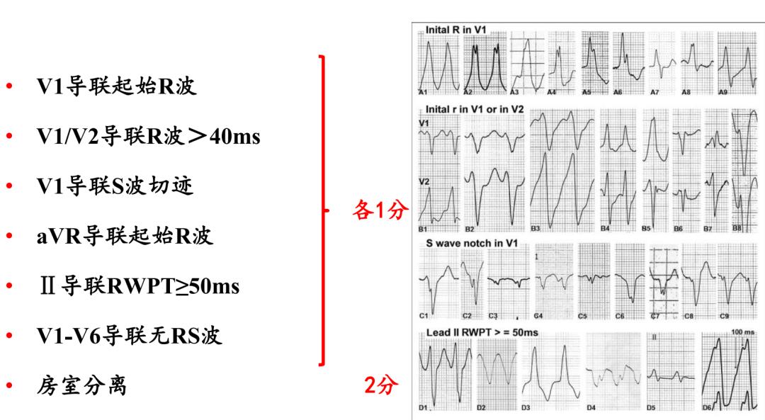 心电图上表现为宽qrs波,心电图中qrs是代表心动过速吗