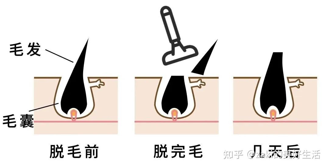 全网最好用的脱毛产品,热门口碑脱毛产品
