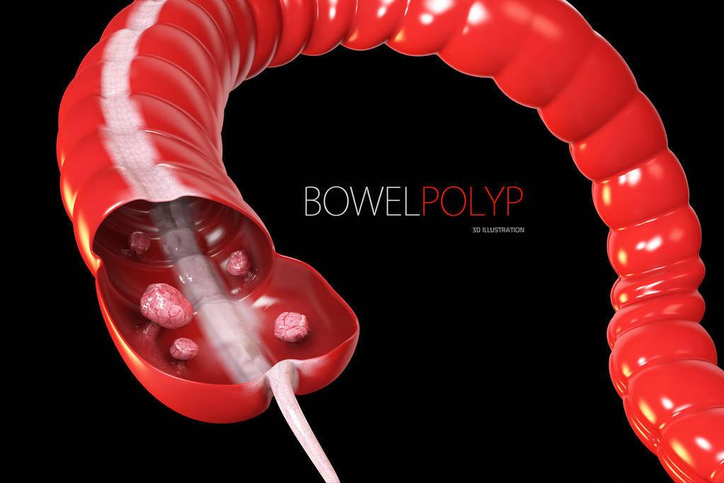 不做手术用药物能根治肠息肉吗,吃什么药能预防肠息肉发生