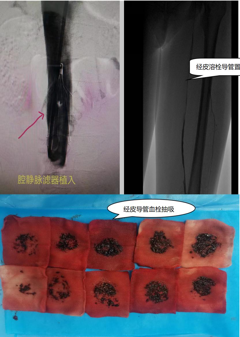 血管介入与介入穿刺的区别,让我们一起认识脑梗
