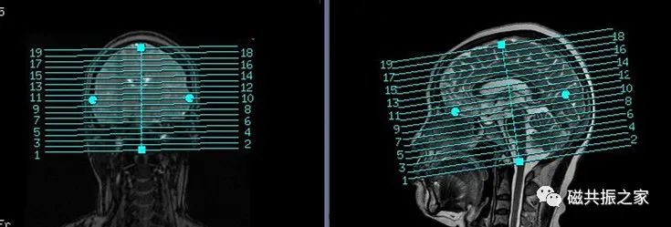 头颅mri的操作步骤,头颅平扫mri能查出什么病