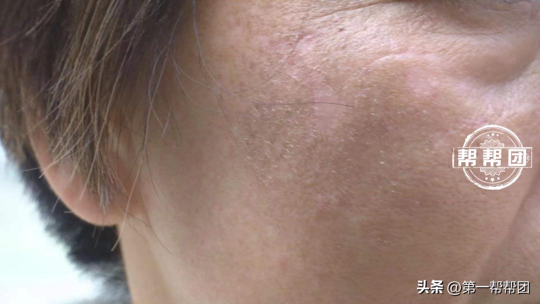 激光祛斑后皮肤出现很多红点,激光祛斑后起疙瘩是怎么回事