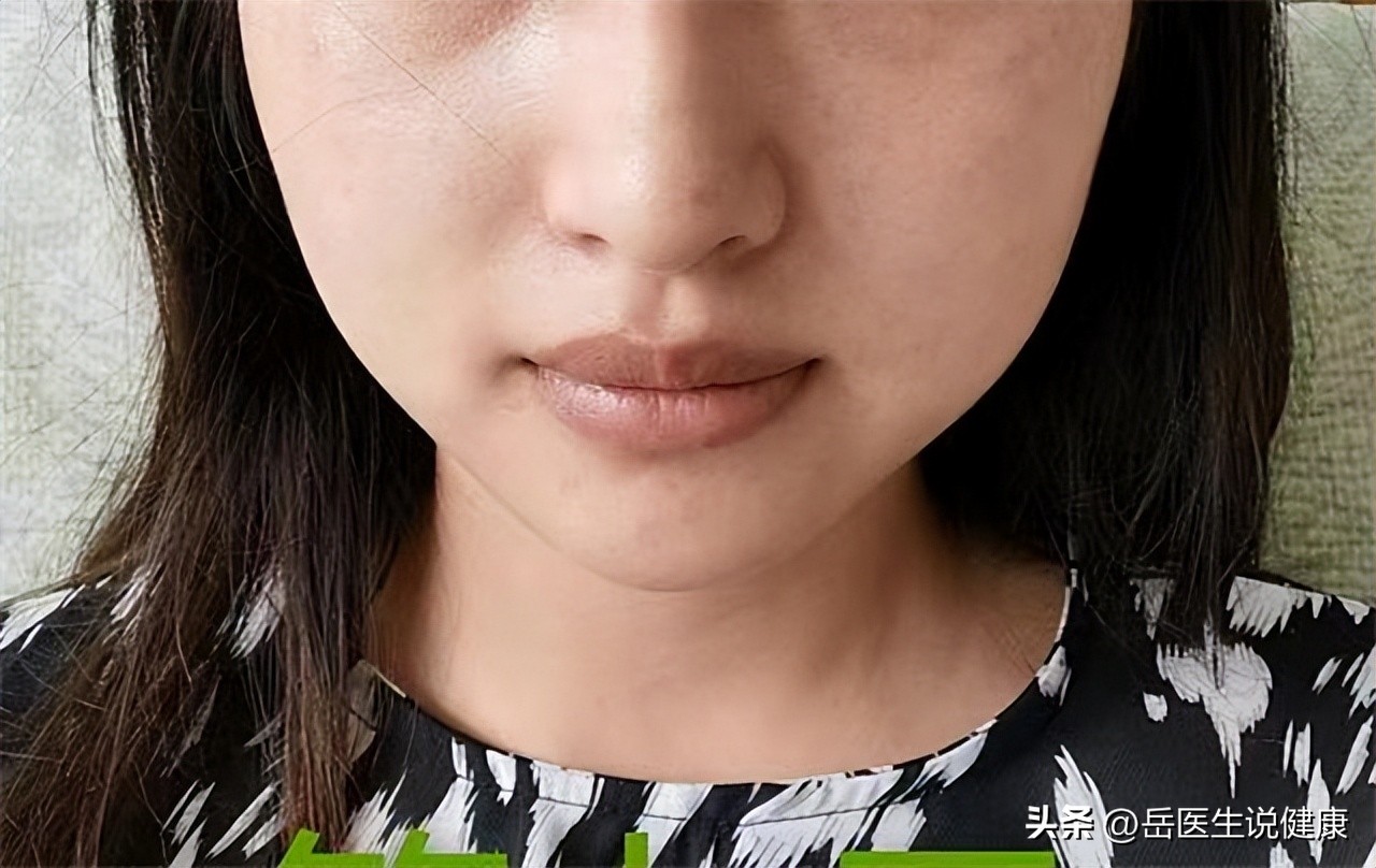 老人斑用红霉素软膏能消斑吗,红霉素软膏可以去除老年斑吗