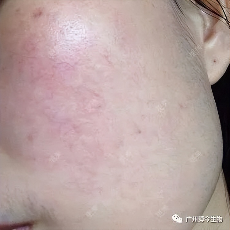 大数据请把这篇文章推给有“黑头”烦恼的人