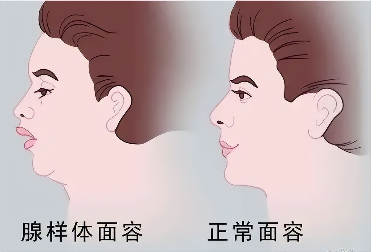 孩子腺样体肥大鼻窦炎家长经验,家长自测儿童腺样体肥大