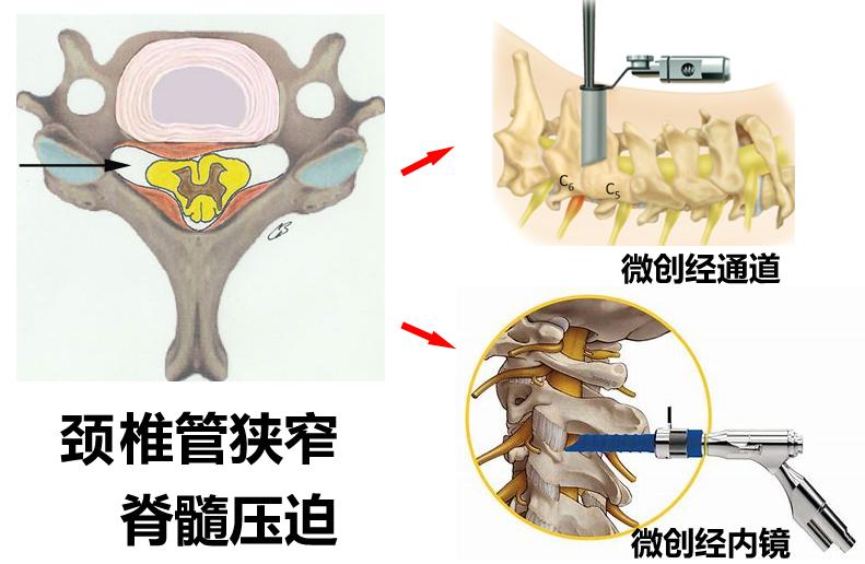 颈椎什么情况可以做微创手术,颈椎什么情况可做微创手术