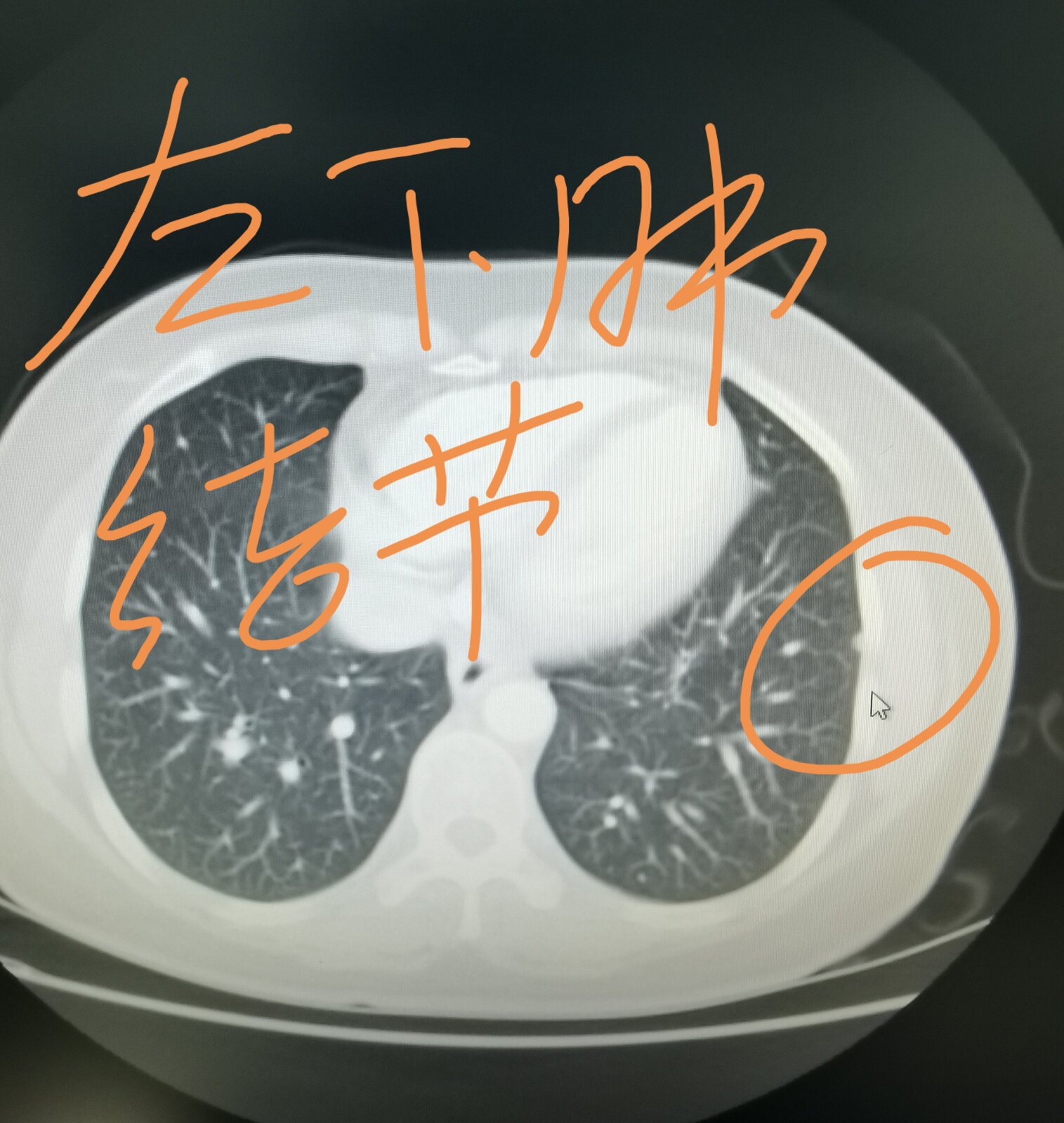 刘懿博士肺癌晚期症状,刘懿博士说肺癌微浸润复发