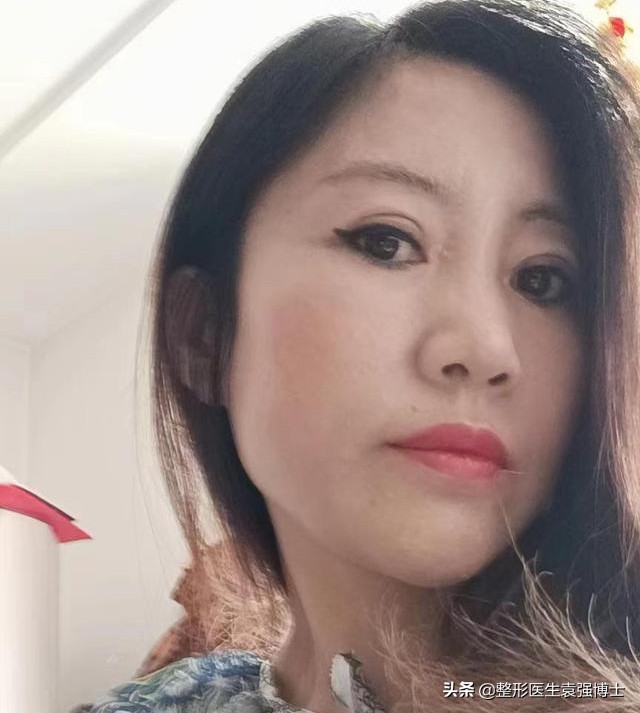 45岁做拉皮多少钱,北京做大拉皮前后对比照片图文