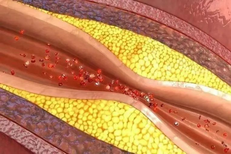 他汀药物什么时候服用,他汀类药物正确服用方法