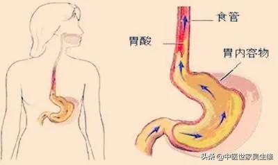 反流性食管炎久不治愈,反流食管炎老是治不好