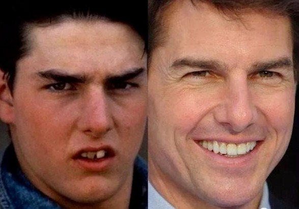 下巴短和后缩怎么变美,下巴后缩怎么矫正嘴尖