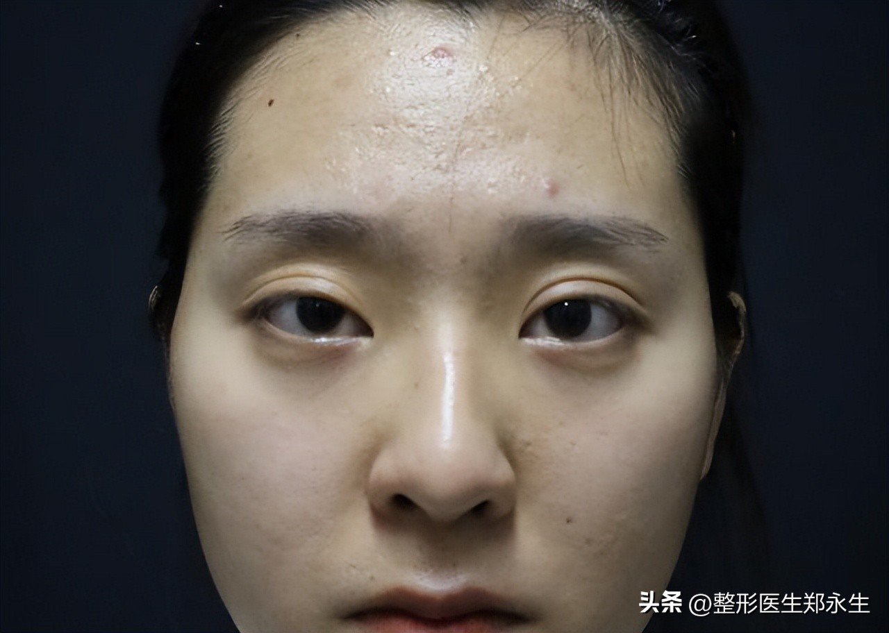 割双眼皮成了大小眼怎么办,双眼皮术后大小眼是什么原因