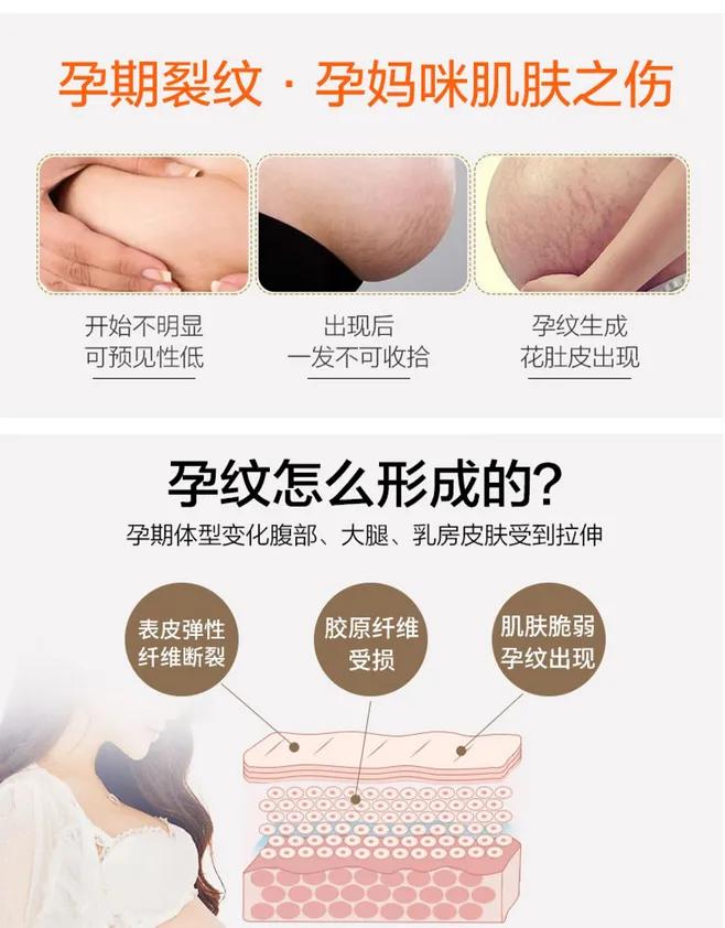 孕期去除妊娠纹最好的办法,孕妇专用妊娠纹去除最好的办法