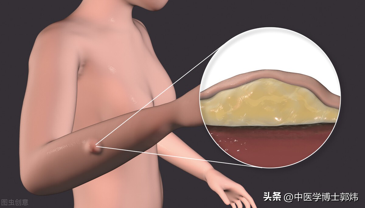 皮肤的肉疙瘩，不痛不痒，选用经方阳和汤，再加两组药，效果更好