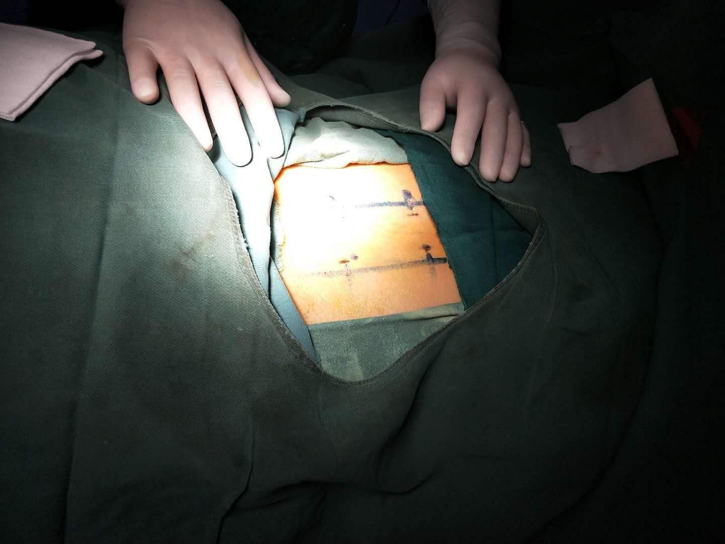 加速康复外科在围手术期的应用,加速康复外科围手术期营养支持