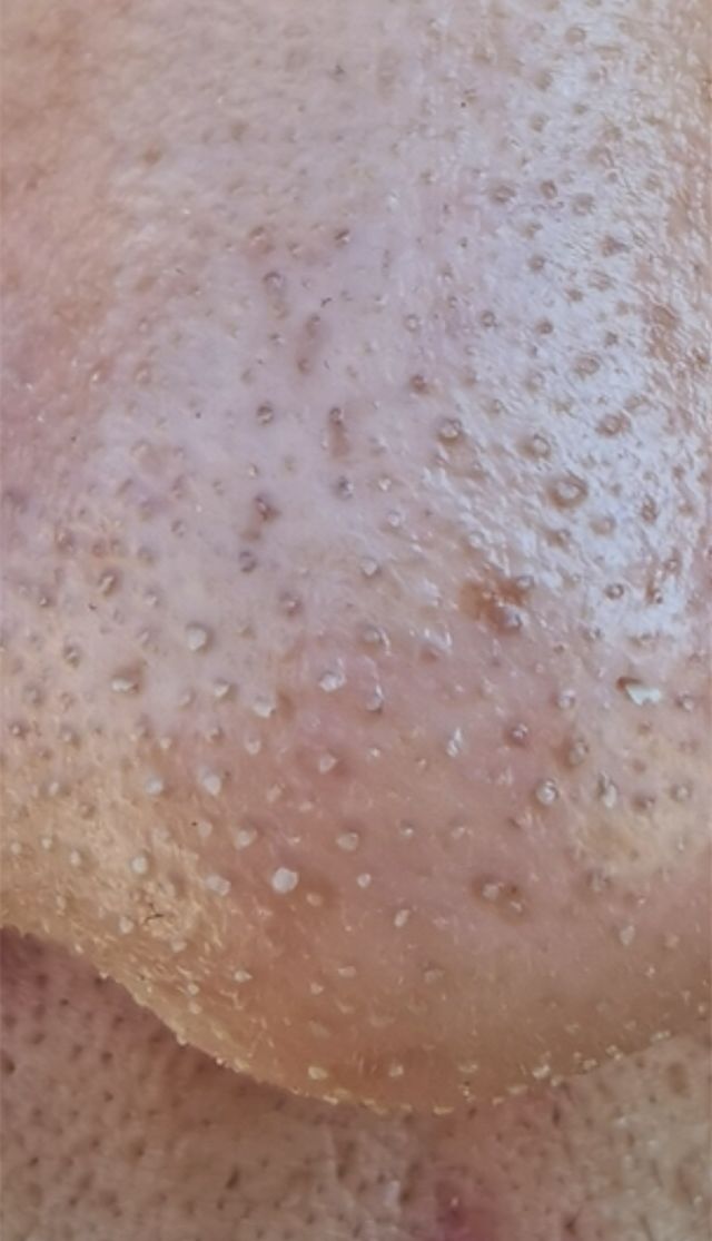 用泥膜真的可以清洁毛孔黑头吗,去黑头收缩毛孔的泥膜