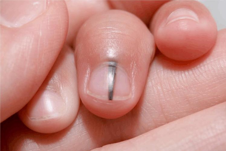 黑痣与肉痣长什么位置不能取,身上黑痣白痣红痣图片