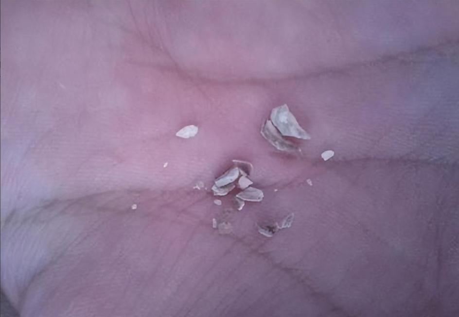 牙齿里小石头,牙齿上的小石头用什么可以去除