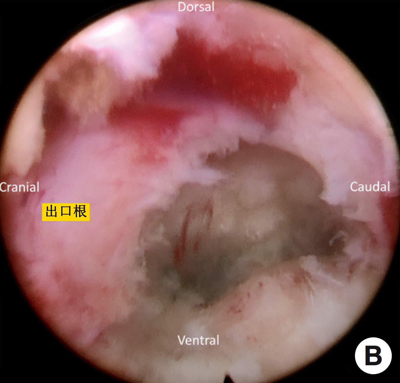 椎间孔镜微创介入治疗椎间盘突出,腰3-4椎间盘突出针刀治疗