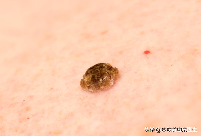 长凸出来的老年斑会是得了癌症吗,40岁老年斑增多是癌症的征兆