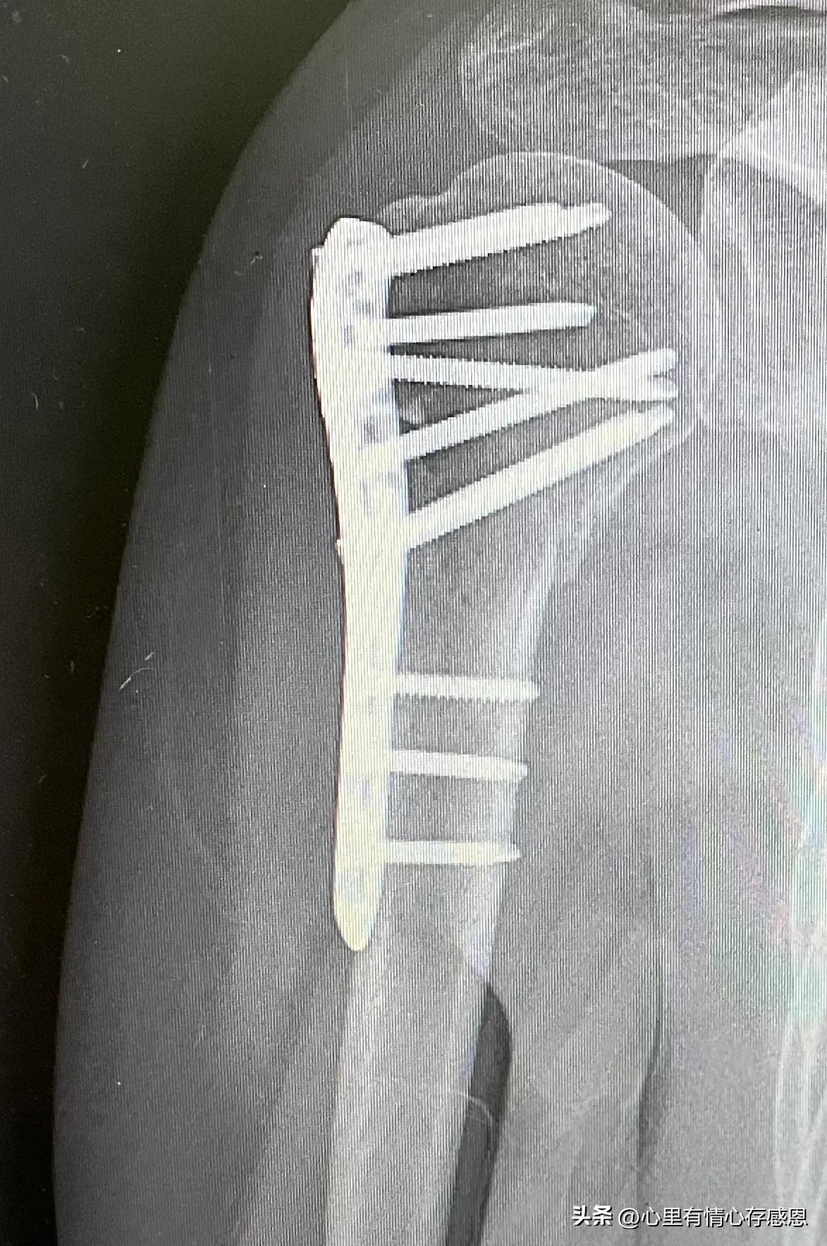手臂骨折后康复训练先做什么,手臂骨折后康复训练最佳时间