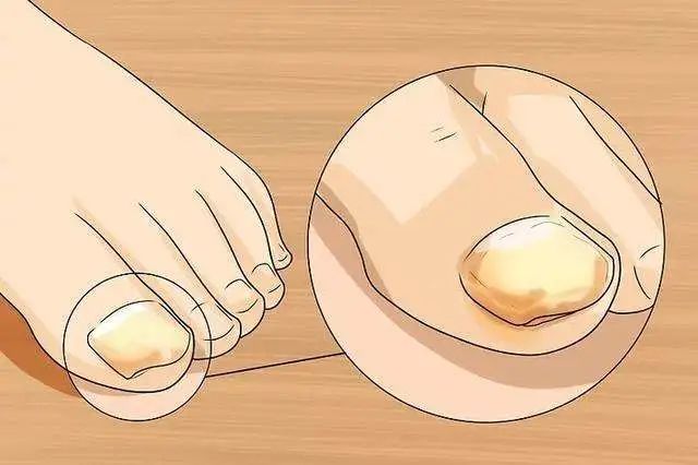 得了灰指甲一个传染俩,灰指甲盖一床被子会传染吗