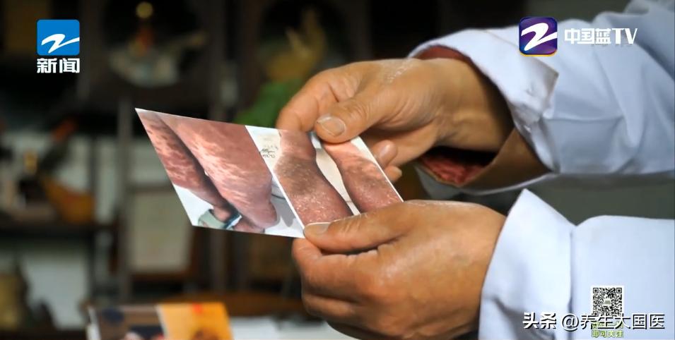 这种“疑难性”皮肤病，中医治疗有独到之处！“简、便、廉、验”四步治疮疡